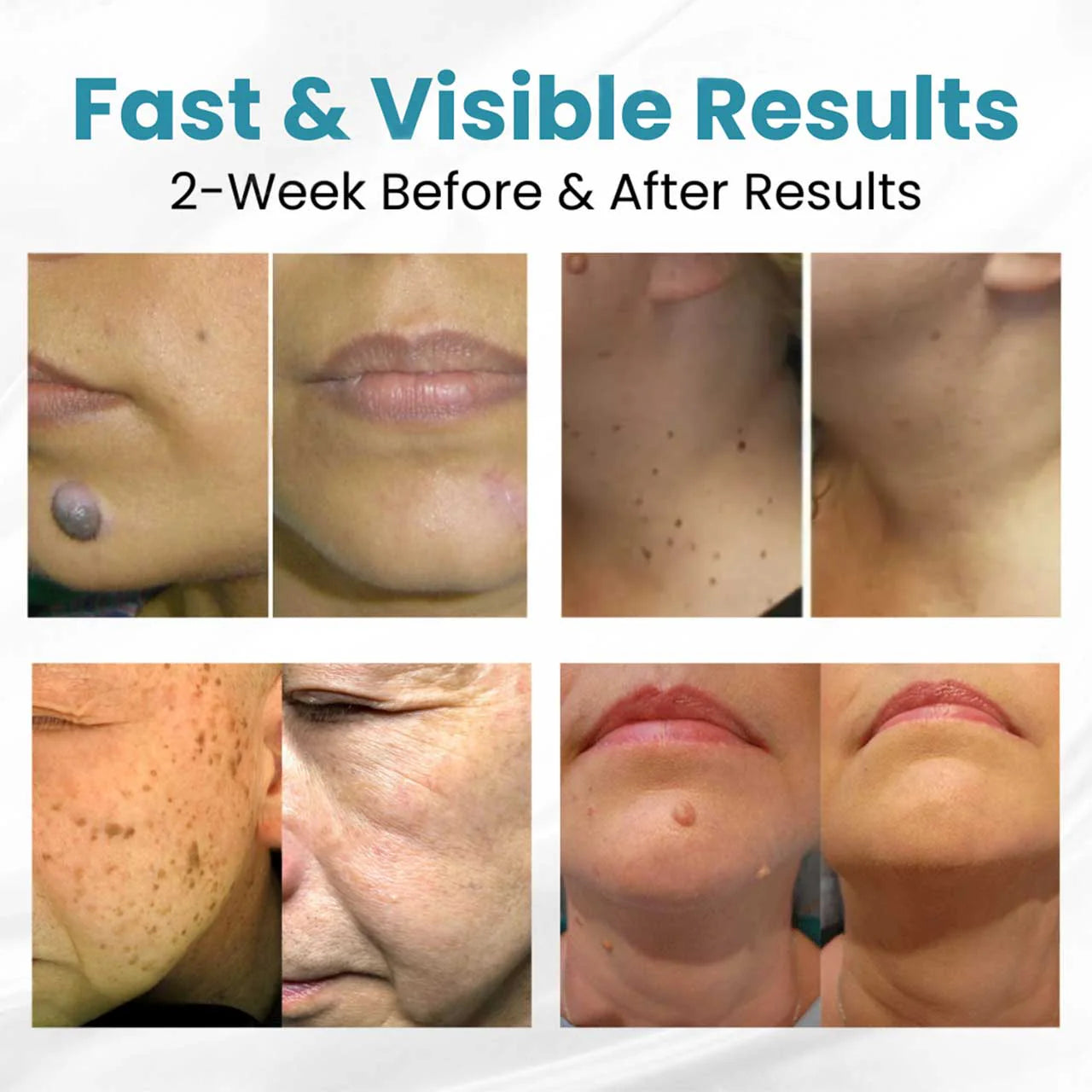 HZA® Non-Invasive Mole and Wart Removal Laser Pen