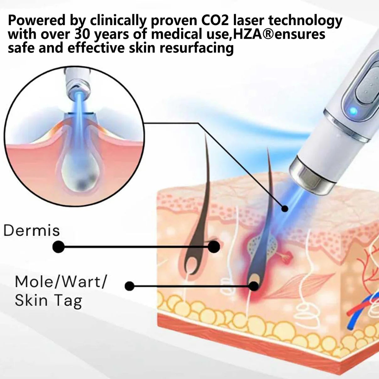 HZA® Non-Invasive Mole and Wart Removal Laser Pen